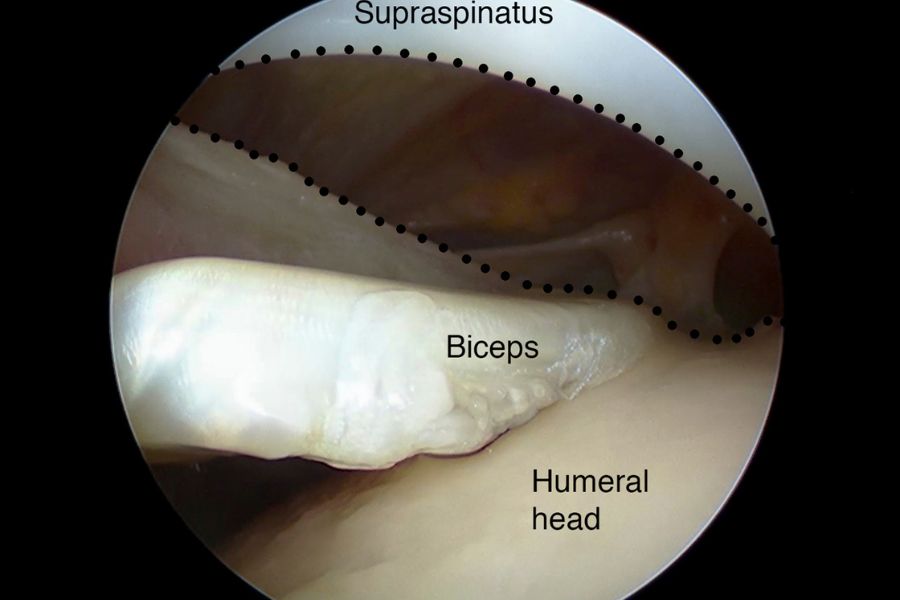 Omuz Tendon Yırtığı Nedir? Belirtileri ve Tedavi Seçenekleri