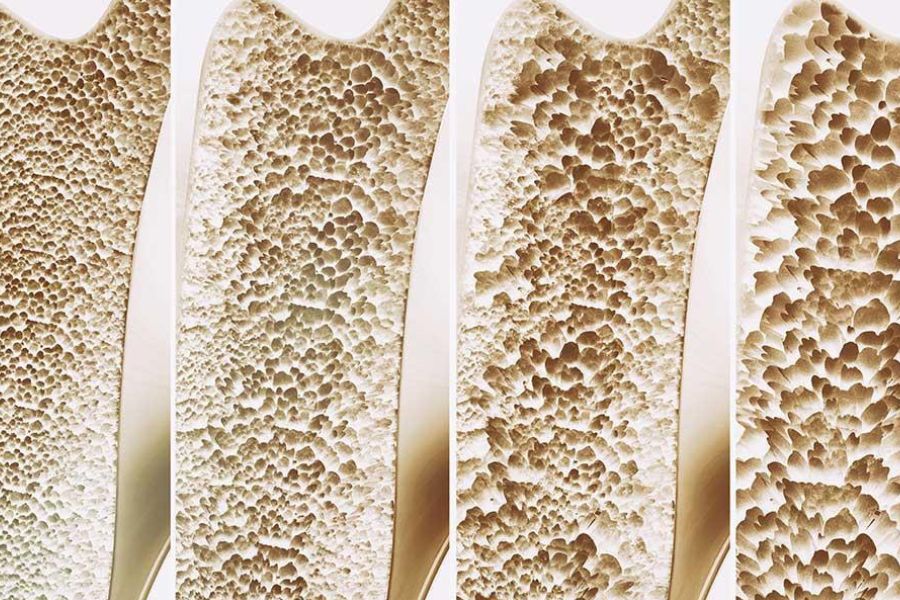 Kemik Erimesi (Osteoporoz) Nedir? Belirtileri ve Tedavi Seçenekleri